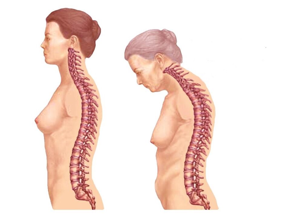 здоровый искривленный позвоночник с остеохондрозом